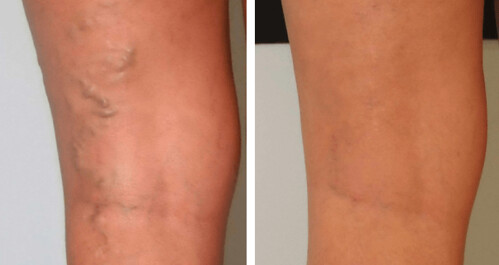 What Are The Best-rated Varicose Vein Removal Services?